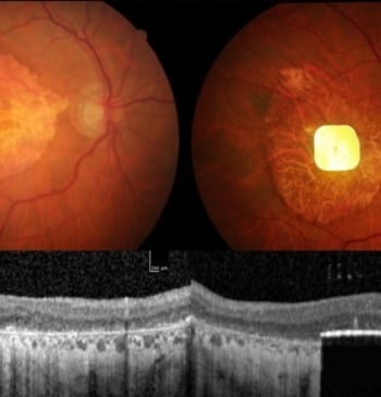 Un dispositivo ocular pionero restaura la visión a personas ciegas
