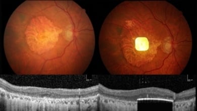 Un dispositivo ocular pionero restaura la visión a personas ciegas