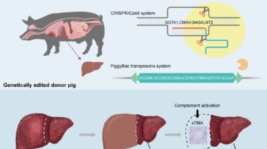 Hito médico: un hombre sobrevive 171 días con un trasplante de hígado de cerdo 