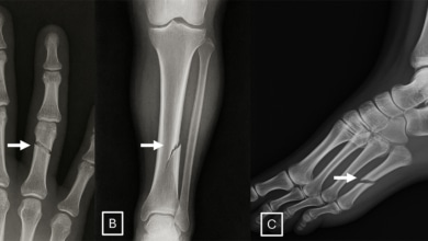 Las radiografías ‘deepfake’ hechas con ChatGPT engañan a radiólogos y a la propia IA