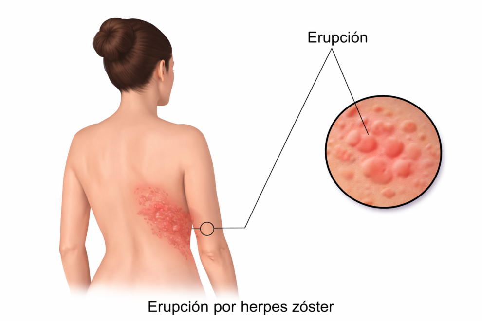 Erupción por herpes zóster