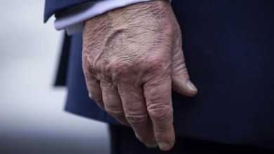 La mala salud de Trump, un secreto a voces