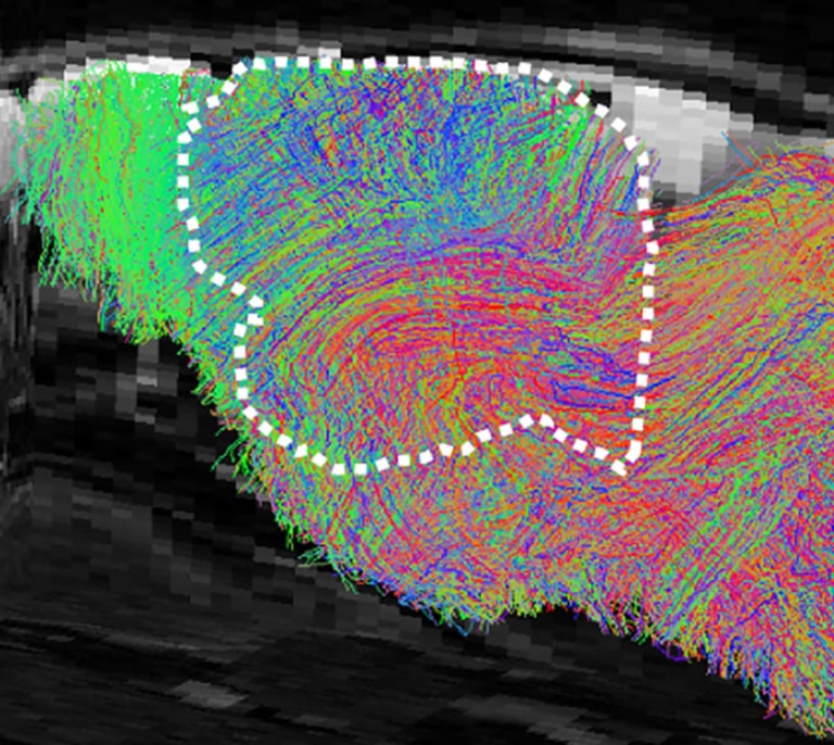 Científicos cultivan tejido cerebral humano en ratones para estudiar trastornos neurológicos