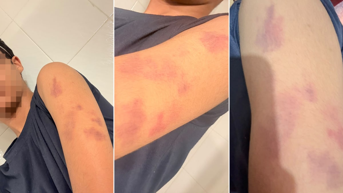 Heridas sufridas por el joven saharaui Ismael Ahmed Salem a raíz de la paliza recibida la semana pasada